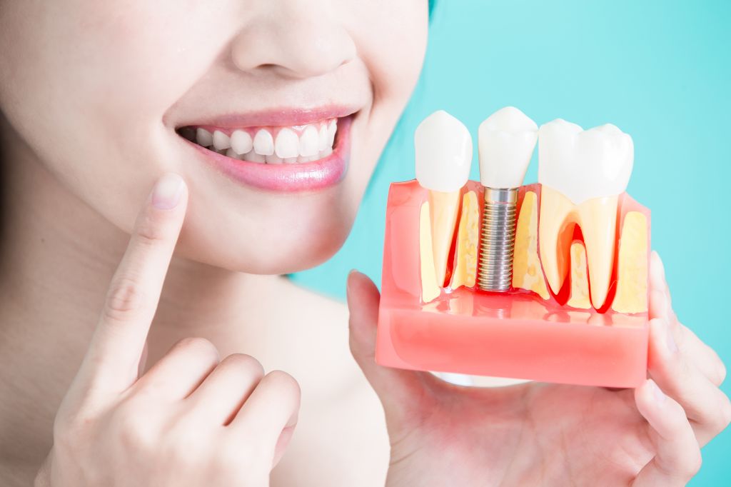 Tot Ce Trebuie S Tii Despre Implanturile Dentare De C Te Tipuri Sunt Unde Se Fac Ce Costuri Au